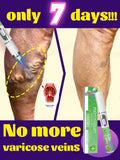 Hot sale Nano Laser Leg Vein